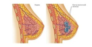 Можно ли ходить в баню при кисте в молочной железе