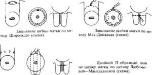 Как проходит операция по наложению шва на шейку матки