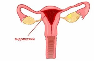 Как выглядит отторгаемый эндометрий во время месячных