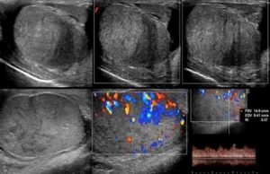 Гематоцеле яичка узи картины