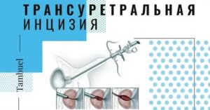 Трансуретральная инцизия предстательной железы это