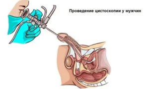 После массажа простаты затрудненное мочеиспускание