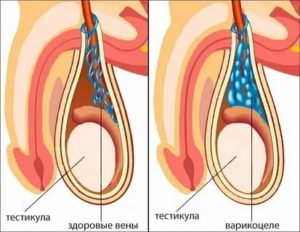 Почему одно яичко больше другого после операции