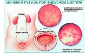 Какая может быть операция при цистите