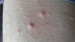 Когда появляются красные пятна на теле при вич