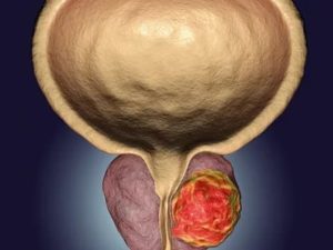 Suspicio tumor предстательной железы