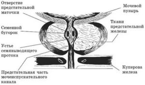 Киста семенного бугорка предстательной железы