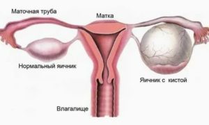 Можно ли лечить кисту яичника мазью вишневского