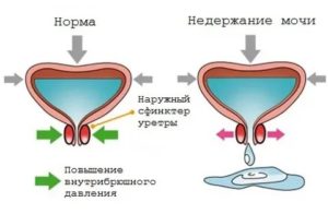 Недержание мочи при удалении рака предстательной железы