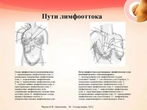 Лимфаденэктомия при раке молочной железы