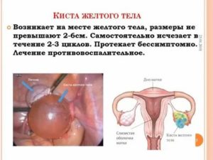 Может ли быть температура при фолликулярной кисте яичника