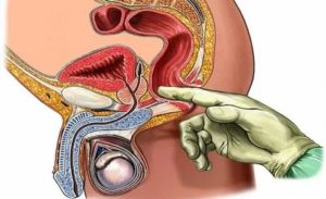 Почему при массаже простаты не выделяется секрет простаты