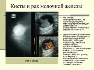 Может ли опухоль молочной железы быть доброкачественной опухоли