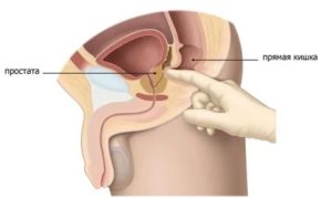Пальпация простаты техника выполнения