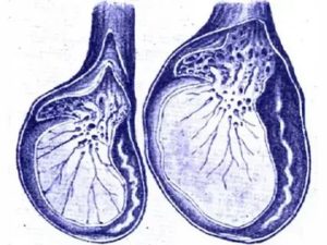 Как атрофируется яичко после операции