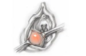 Что такое марсупиализация кисты бартолиновой железы отзывы