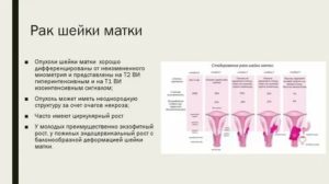 Как вылечиться от рака шейки матки 2 стадии