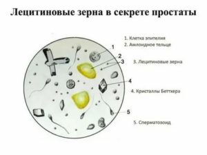 Лецитиновые зерна в моче после массажа простаты