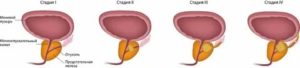 Может ли аденома простаты перерасти в злокачественную опухоль