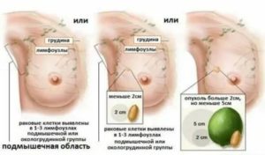 Может ли быть рак молочной железы у подростков