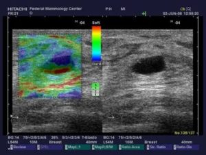 Узи молочной железы с эластографией отзывы