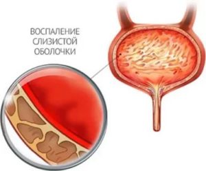 Как восстановить слизистую мочевого пузыря при хроническом цистите