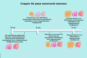 Что такое рак молочной железы в нулевой стадии