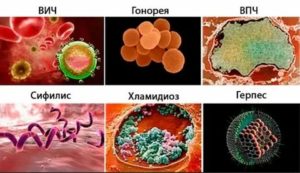 Что такое сифилис гонорея спид герпес