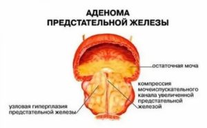 Заговоры от аденомы предстательной железы