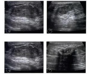 На узи гипоэхогенное образование молочной железы что это такое