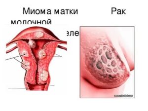 Что если миома матки переросла в злокачественную опухоль