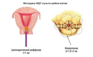 Фотосенсибилизация при раке шейки матки