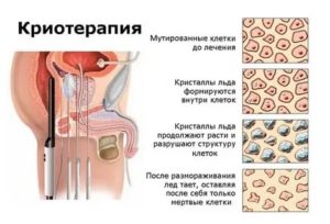 Криоабляция предстательной железы