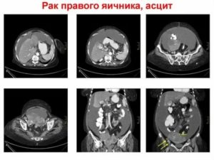 Асцит после химиотерапии при раке яичников отзывы