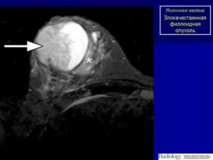 Филлоидная злокачественная опухоль молочной железы
