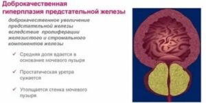 С образованием средней доли предстательной железы