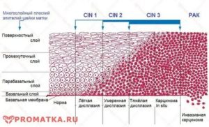Как лечить дисплазию шейки матки 2 степени без операции