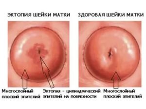 Может ли эрозия шейки матки перерасти в рак отзывы