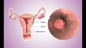 Как часто полип в матке перерождается в рак