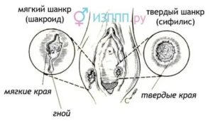 Как выглядит сифилис на половых органах у женщин