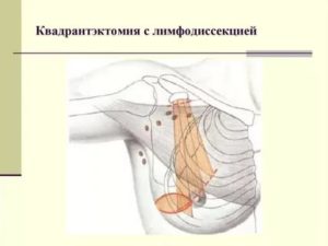 Лимфаденэктомия при раке молочной железы