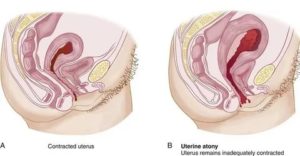 Что делать если сокращается матка при месячных