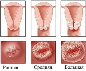Покраснение на шейке матки при молочнице