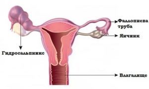 Как можно лечить гидросальпинкс без операции