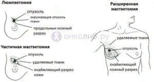 Аднексэктомия при раке молочной железы