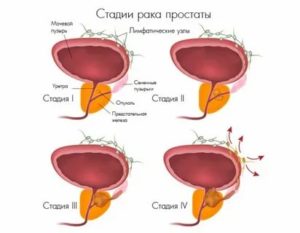 Рак простаты у мужчин симптомы лечение 3 степени что нужно сделать чтобы