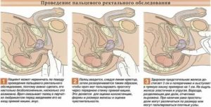 Может ли мужчина заниматься сексом если у него был рак предстательной железы