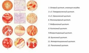 Что такое фиброзный цистит
