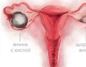 Как принимать силуэт при кисте яичника