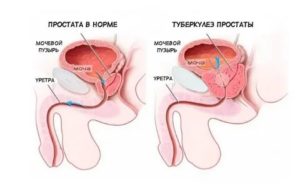 Взятие сока предстательной железы отзывы